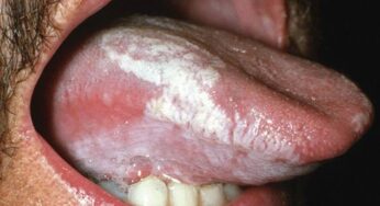 Oral Hairy Leukoplakia: Indikator Awal HIV yang Perlu Diketahui