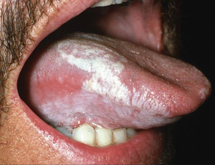 oral hairy leukoplakia